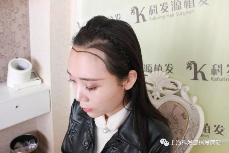 上海抖音小姐姐发际线调整植发改变大额头