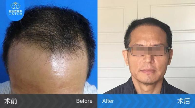 50多岁发际线植发眉毛种植术后19天的正面照