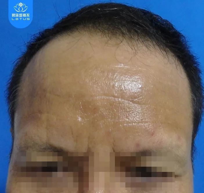 50多岁发际线植发眉毛种植术后19天的正面照