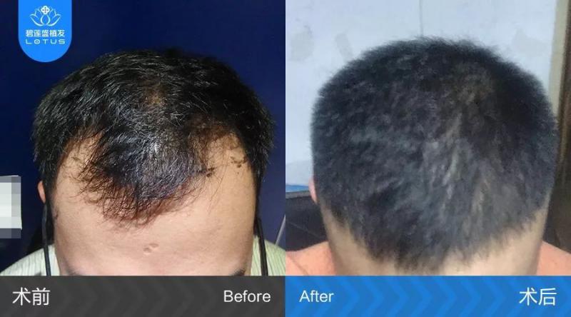 M型脱发3年植发5个月告别头发问题
