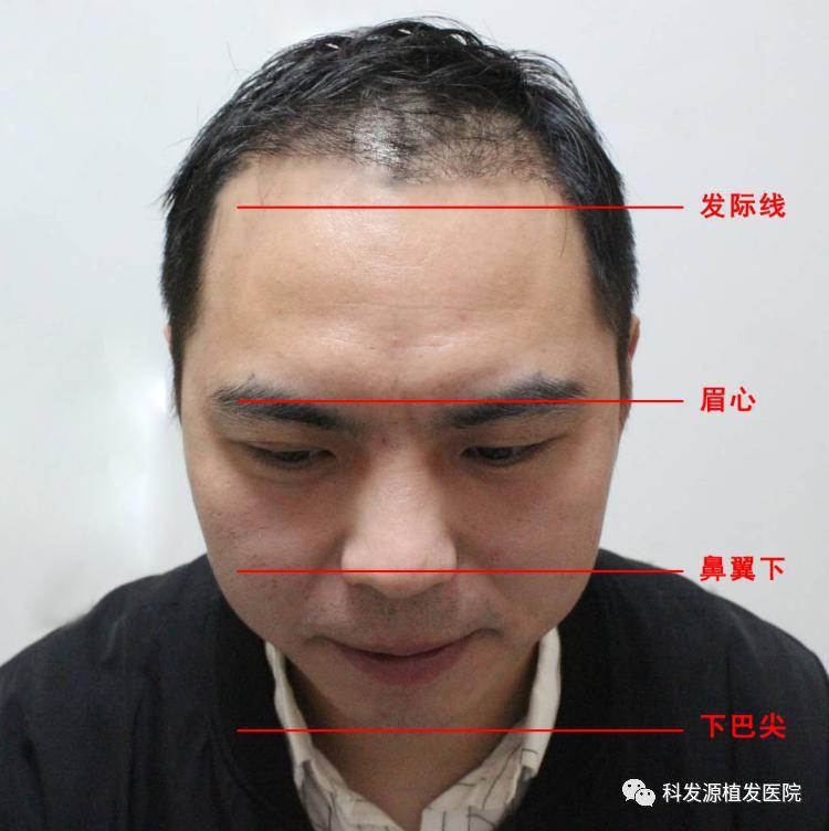 科发源员工上海微针植发效果展示