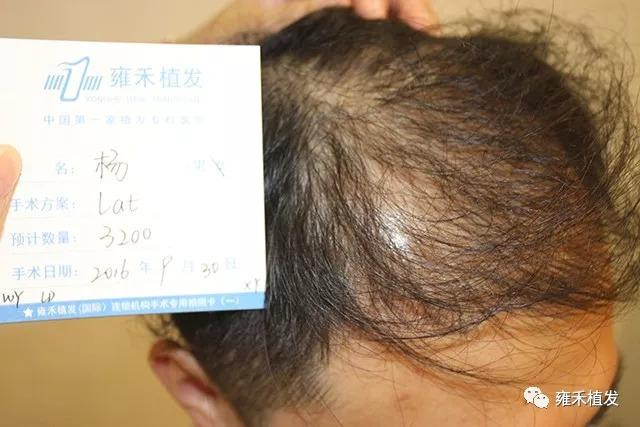 杨先生北京植发点阵加密3200毛囊移植