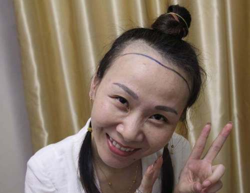 韩国籍越女士植发全过程遇见更好的自己