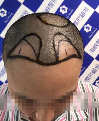 福州脂溢性脱发男无痕植发七个月案例