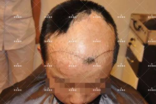男 | 疤痕性植发 | 1年