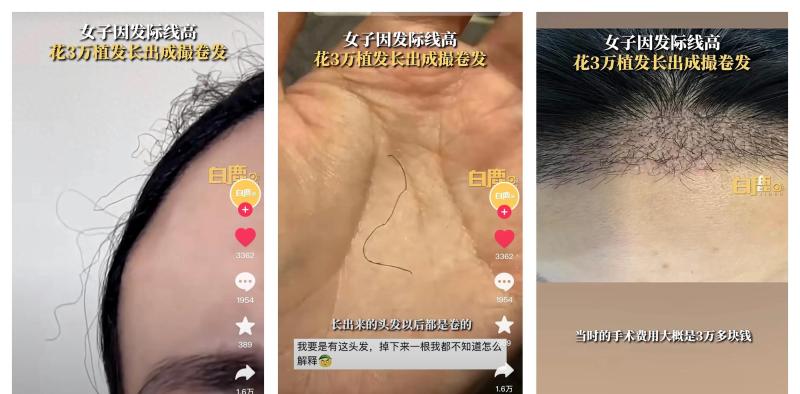 北京一女子花3万植发，长出成撮卷毛 网友调侃：这是来自腋窝吗