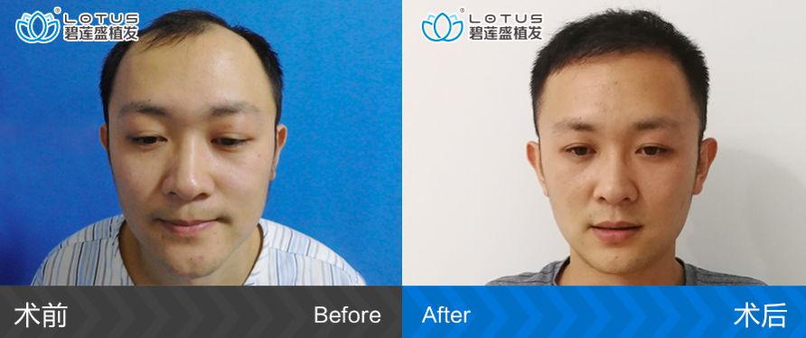 王先生5级脱发无痕植发后恢复过程