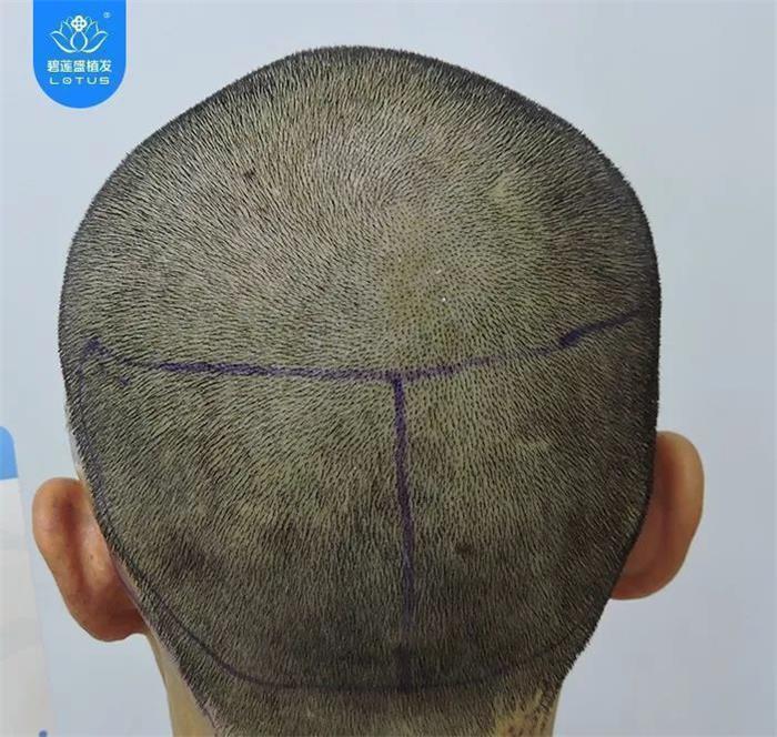 头部烫伤疤痕植发修复方案共计种植3000毛囊单位
