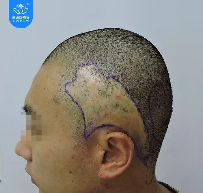 头部烫伤疤痕植发修复方案共计种植3000毛囊单位