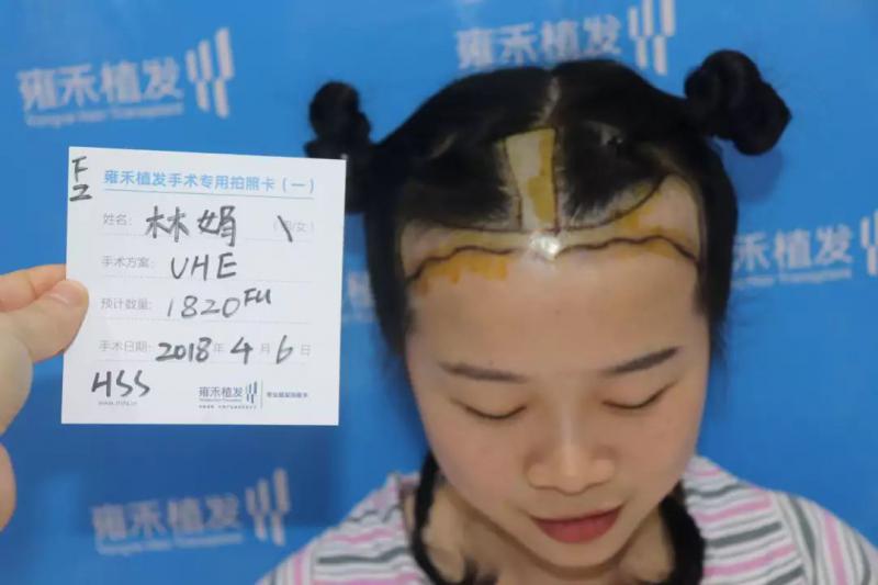雍禾美女医生给自己植发头顶加密发际线种植