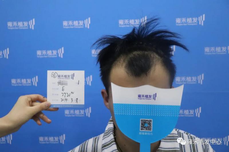 青岛雍禾用FUE为侯先生植发2731单位雍禾植发改变了他。