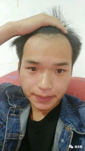 杭州男性植发术后9个月，高脑门终于不见了