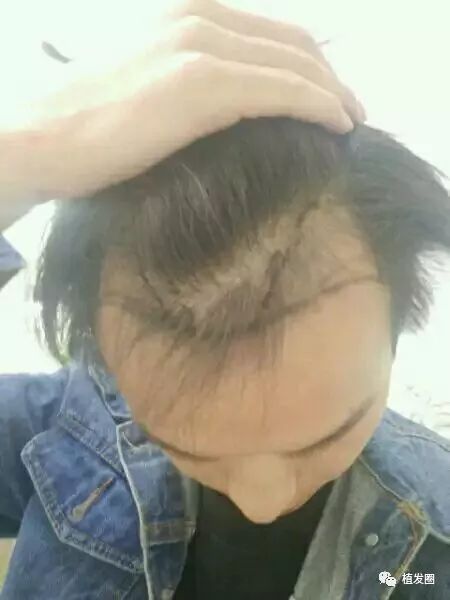 杭州男性植发术后9个月，高脑门终于不见了