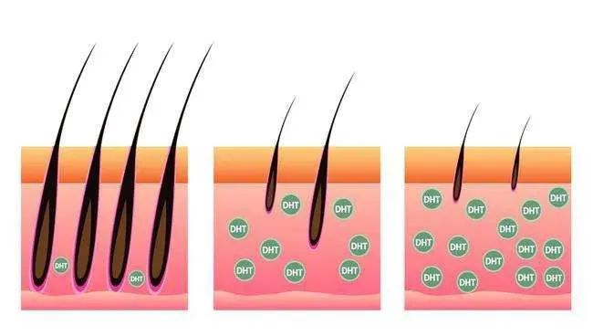 女性也会雄激素性脱发！别让雄脱偷走你的秀发！