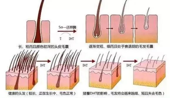 女性也会雄激素性脱发！别让雄脱偷走你的秀发！