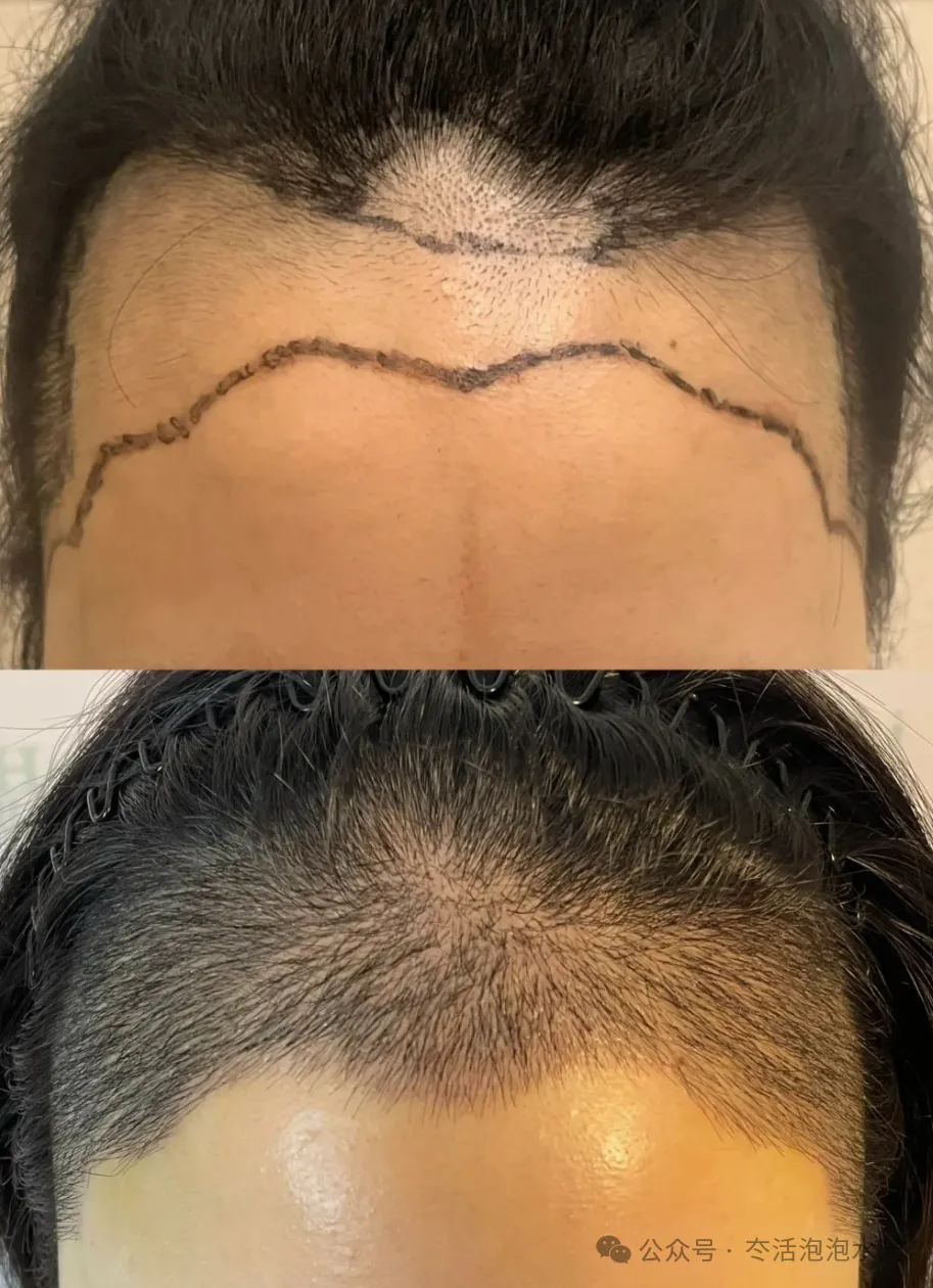 植发我真的劝累了...
