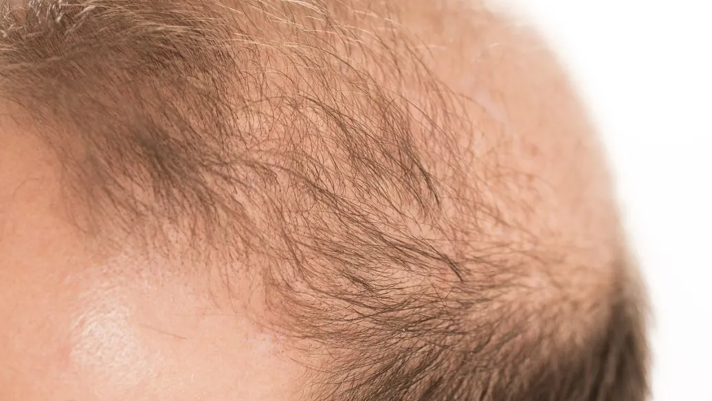 毛发移植——“拆东墙补西墙”的艺术与科学