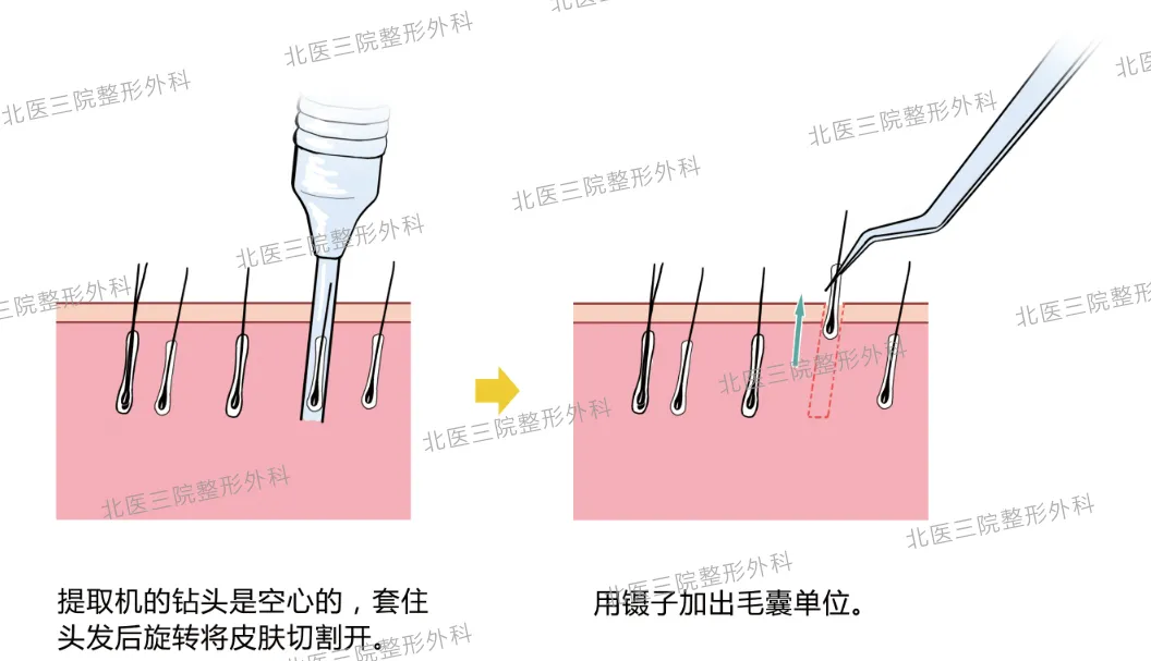 毛发移植——“拆东墙补西墙”的艺术与科学