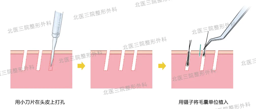 毛发移植——“拆东墙补西墙”的艺术与科学