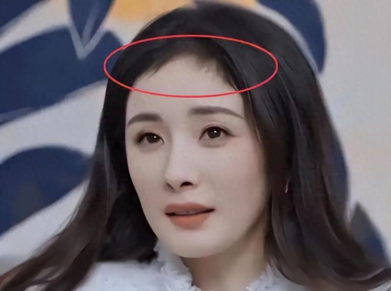 为什么明星植发都选高端植发技术