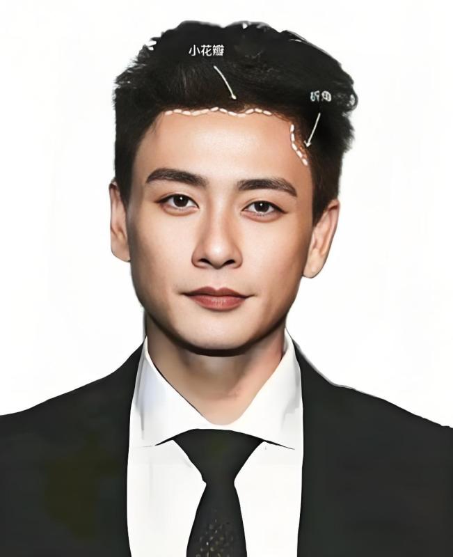 为什么明星植发都选高端植发技术