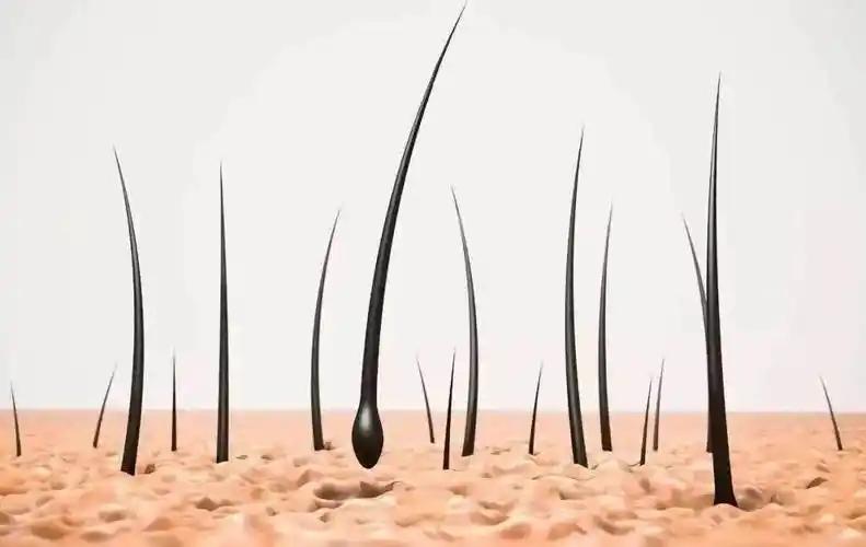 植发医生从不对外说的技术内幕,今天一次性讲清楚