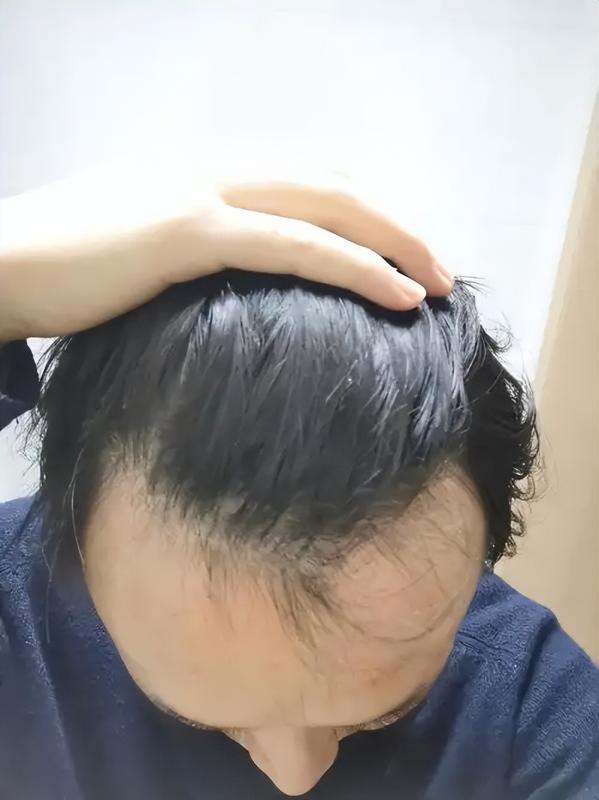 2025最新植发技术排名：FUE已不是最佳选择？