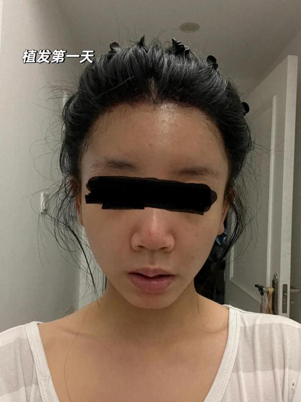 不剃发植发！全网没人敢说的真话 ！我来补充！