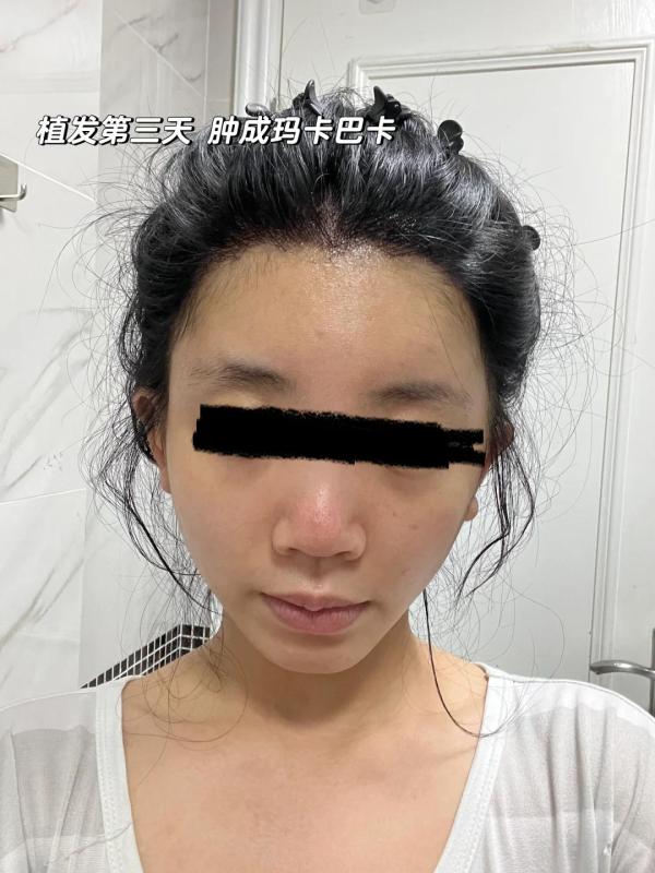 不剃发植发！全网没人敢说的真话 ！我来补充！