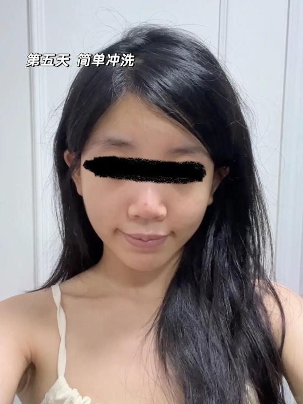 不剃发植发！全网没人敢说的真话 ！我来补充！