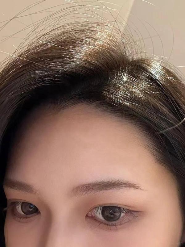 扎马尾星人有救了！植发2700单位满月日记