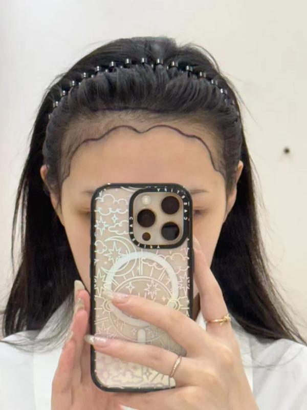 扎马尾星人有救了！植发2700单位满月日记