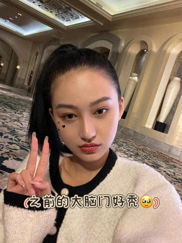 我的植发+鬓角小心机，头包脸效果太香了