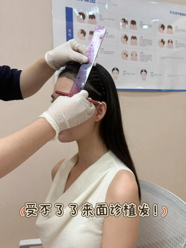 我的植发+鬓角小心机，头包脸效果太香了