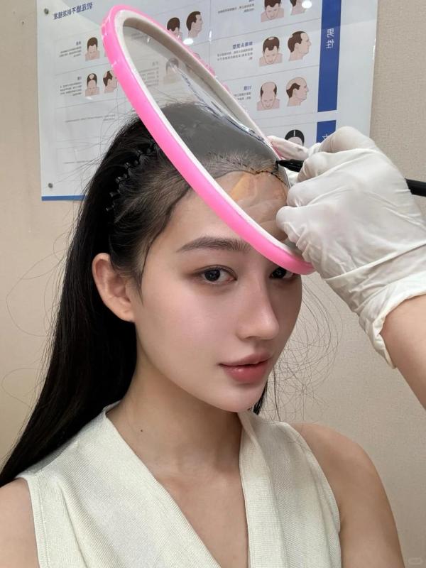 我的植发+鬓角小心机，头包脸效果太香了