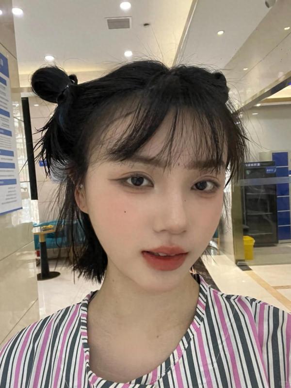 家人们我的大额头有救了！3000单位不剃发植发日记