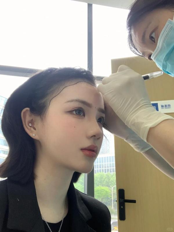 家人们我的大额头有救了！3000单位不剃发植发日记