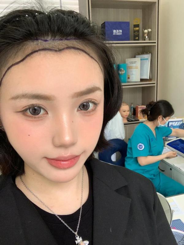 家人们我的大额头有救了！3000单位不剃发植发日记