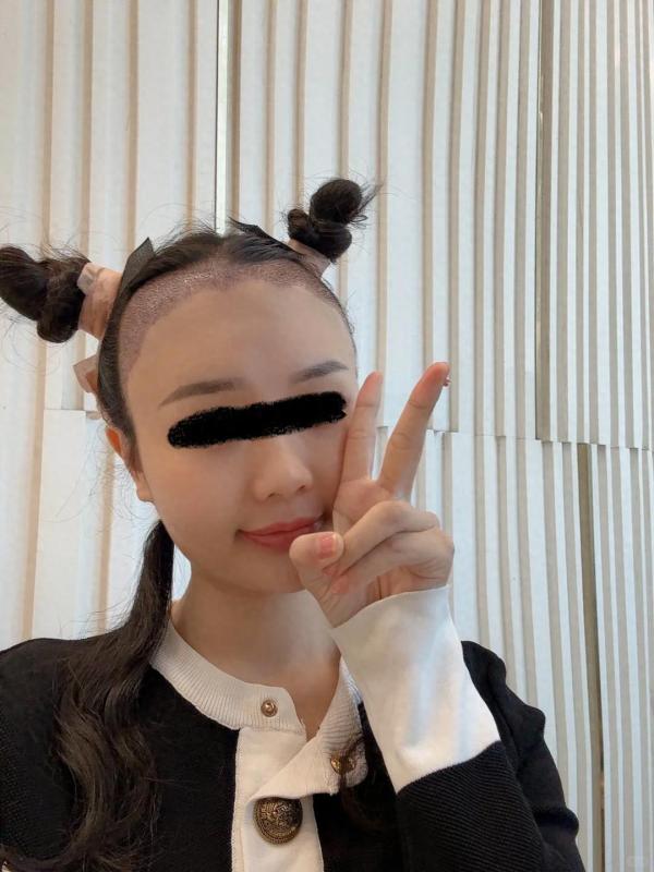植发一周是什么感觉，看看来自云南的小姐姐怎么说