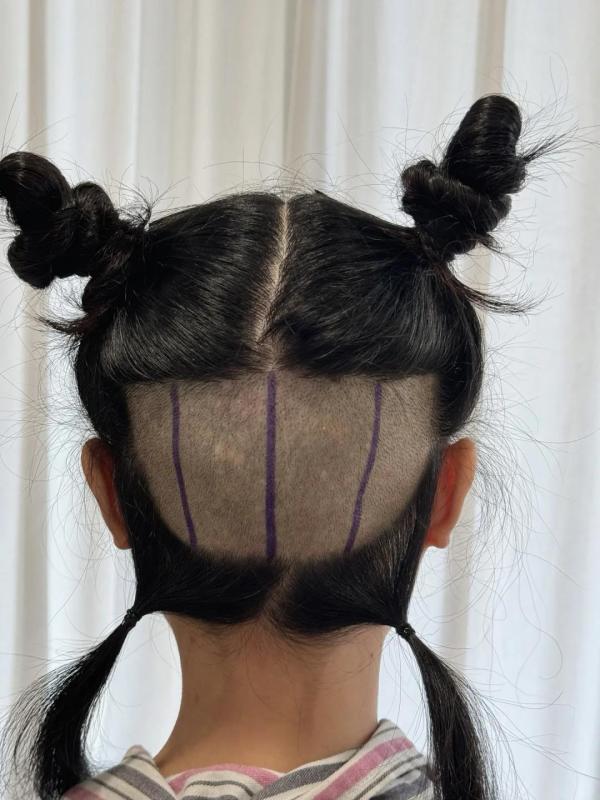 植发一周是什么感觉，看看来自云南的小姐姐怎么说