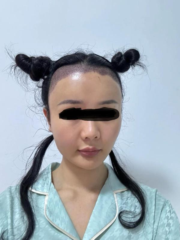 植发一周是什么感觉，看看来自云南的小姐姐怎么说