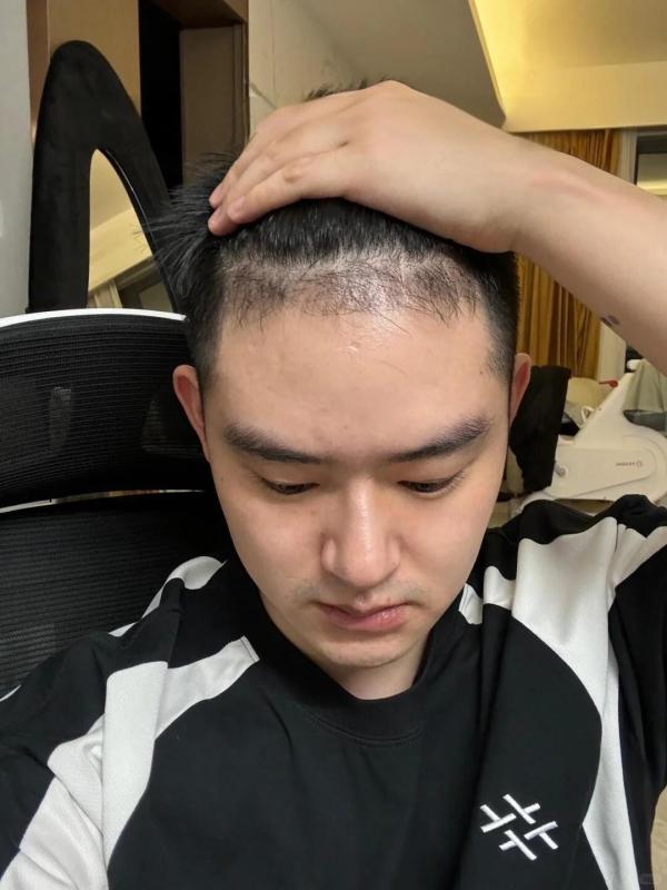 上海小姐姐就是不一样，不仅自己植发还带老公一起卷