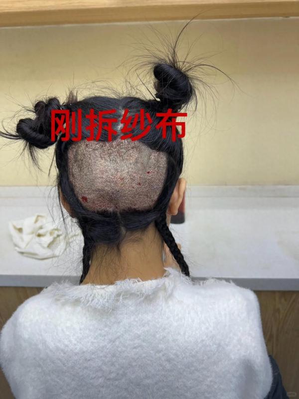 上海小姐姐，分享她植发10天的记录真勇敢！