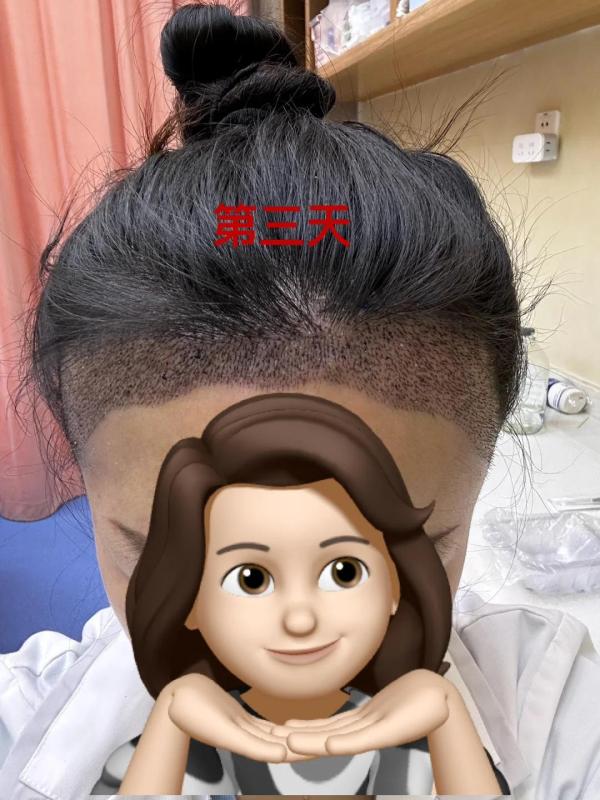 上海小姐姐，分享她植发10天的记录真勇敢！