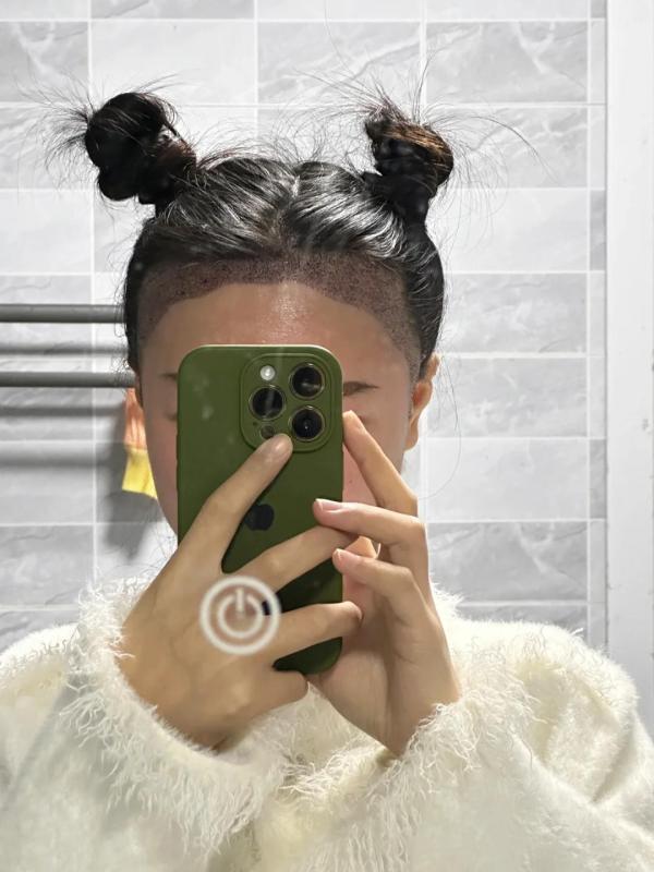 上海小姐姐，分享她植发10天的记录真勇敢！