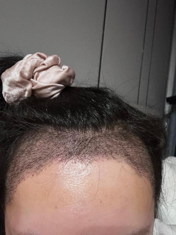 一位来云南的小姐姐分享她的植发后的记录，小姐姐真棒！