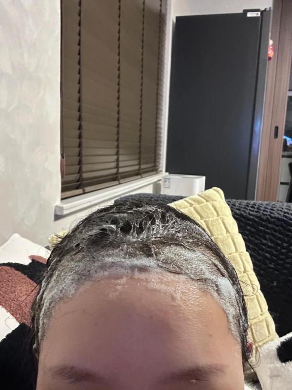 一位来云南的小姐姐分享她的植发后的记录，小姐姐真棒！