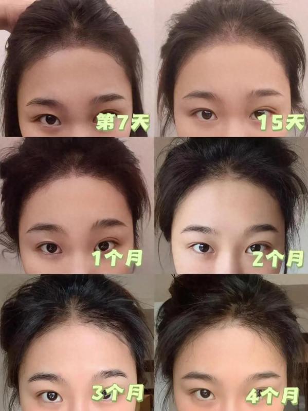 广东的小姐姐分享：不剃发植发满一年，发际线生长全记录