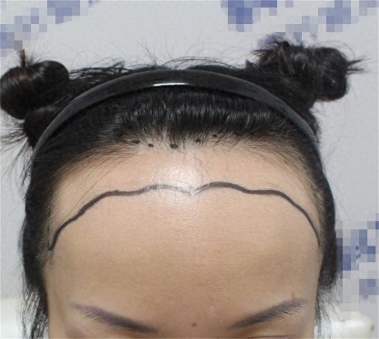 北京植发5万，县城8000：差价背后藏着多少猫腻？