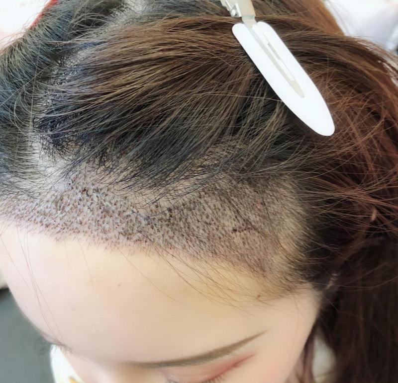 北京植发5万，县城8000：差价背后藏着多少猫腻？